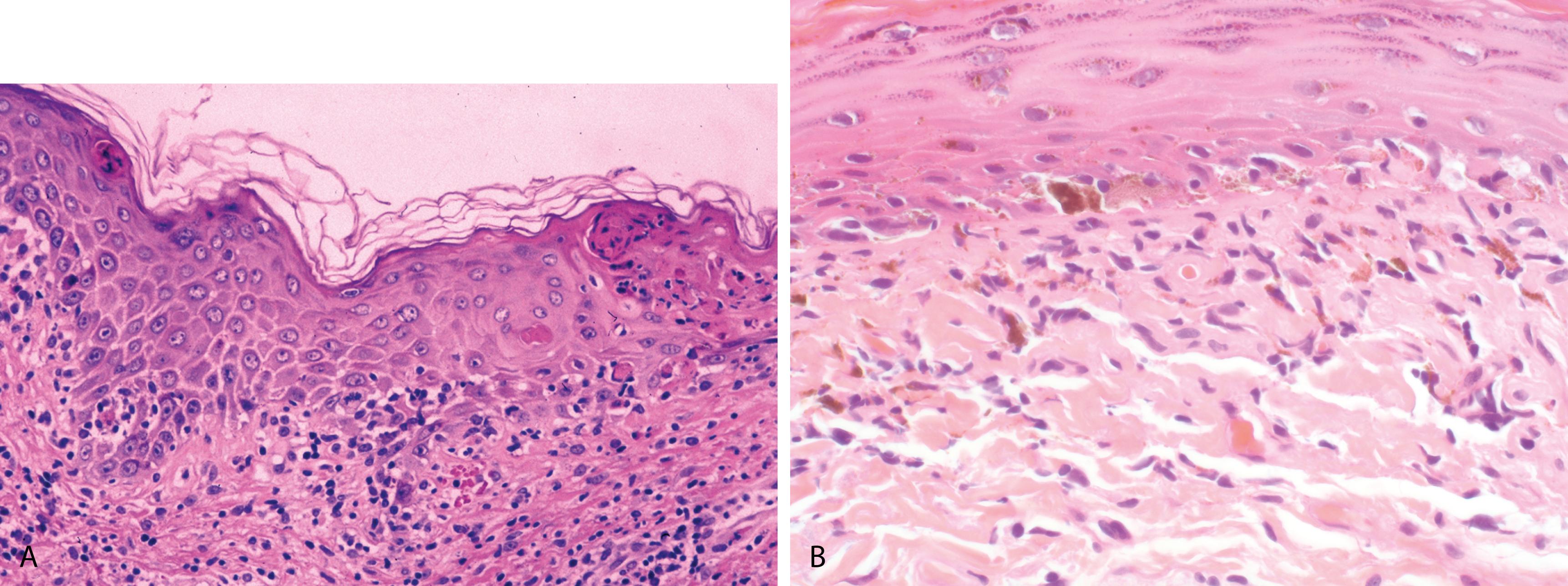 Figure 2.17, A, Fixed drug eruption. Necrotic keratinocytes in the epidermis, vacuolar alteration of the basal cell layer, and patchy lichenoid inflammatory cell infiltrate that obscures the dermoepidermal junction are seen. Histologic changes are similar to those seen in erythema multiforme. B, Erythema dyschromicum perstans. Interface change with prominent underlying pigment incontinence.