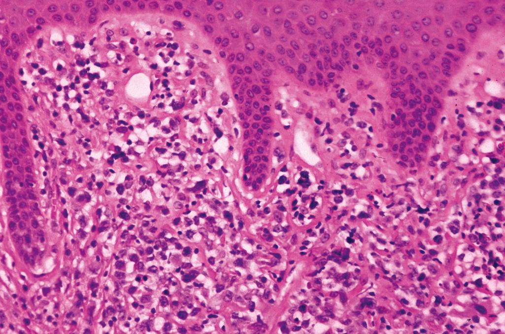 Figure 2.18, Lymphomatoid papulosis.