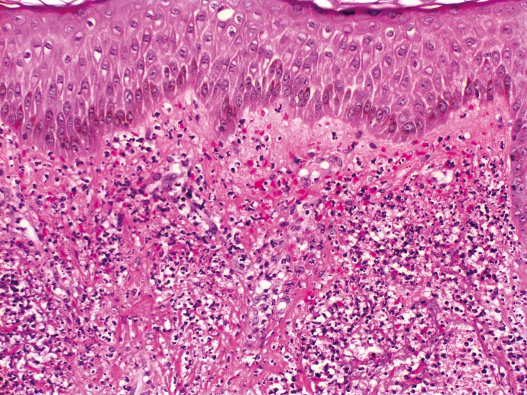 Figure 2.20, Sweet syndrome.