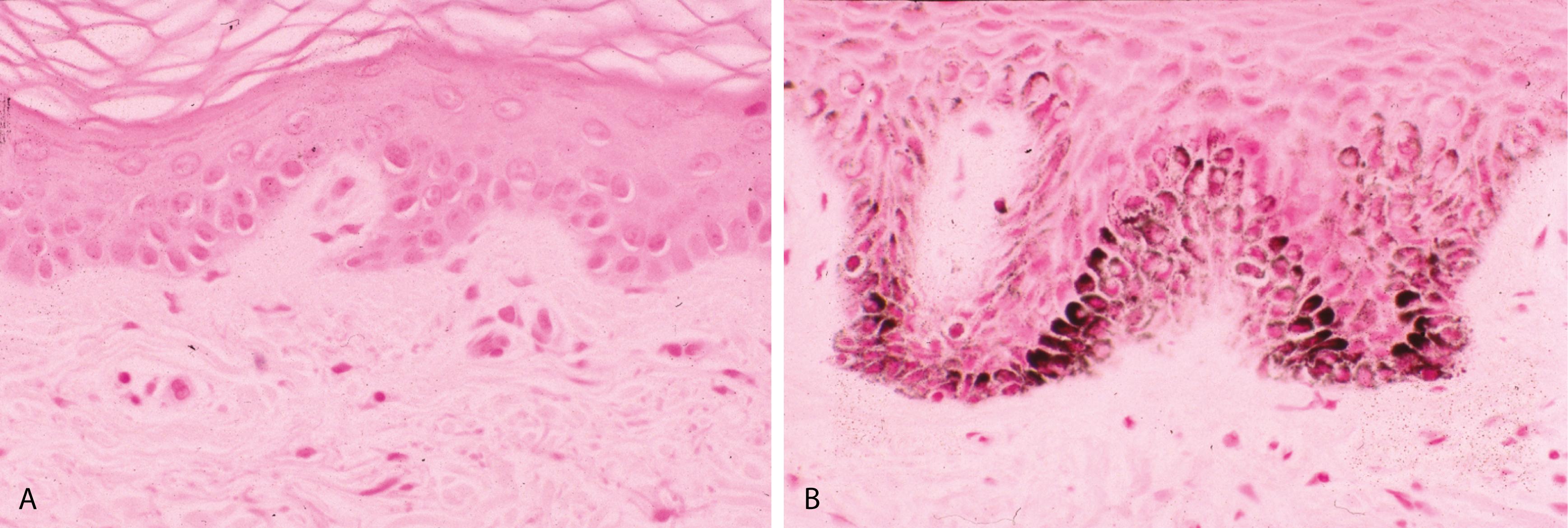 Figure 2.2, A, Vitiligo. Fontana-Masson stain shows loss of pigmentation at the basal cell layer. B, Normal skin. Fontana-Masson stain shows normal pigmentation at the basal cell layer.