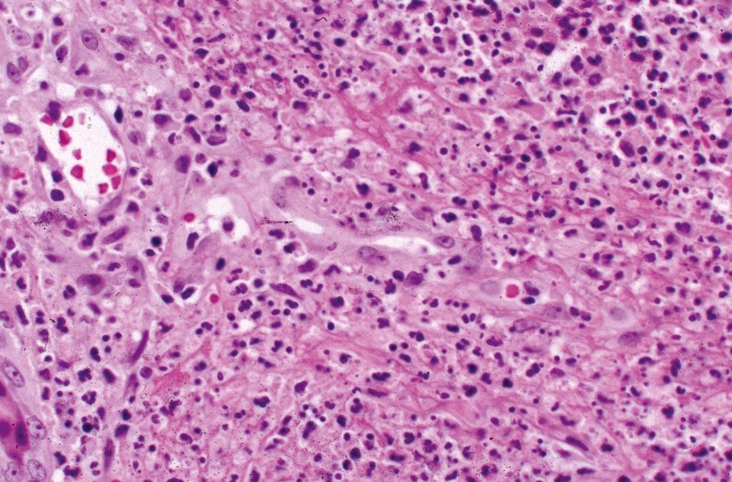 Figure 2.21, Pyoderma gangrenosum.