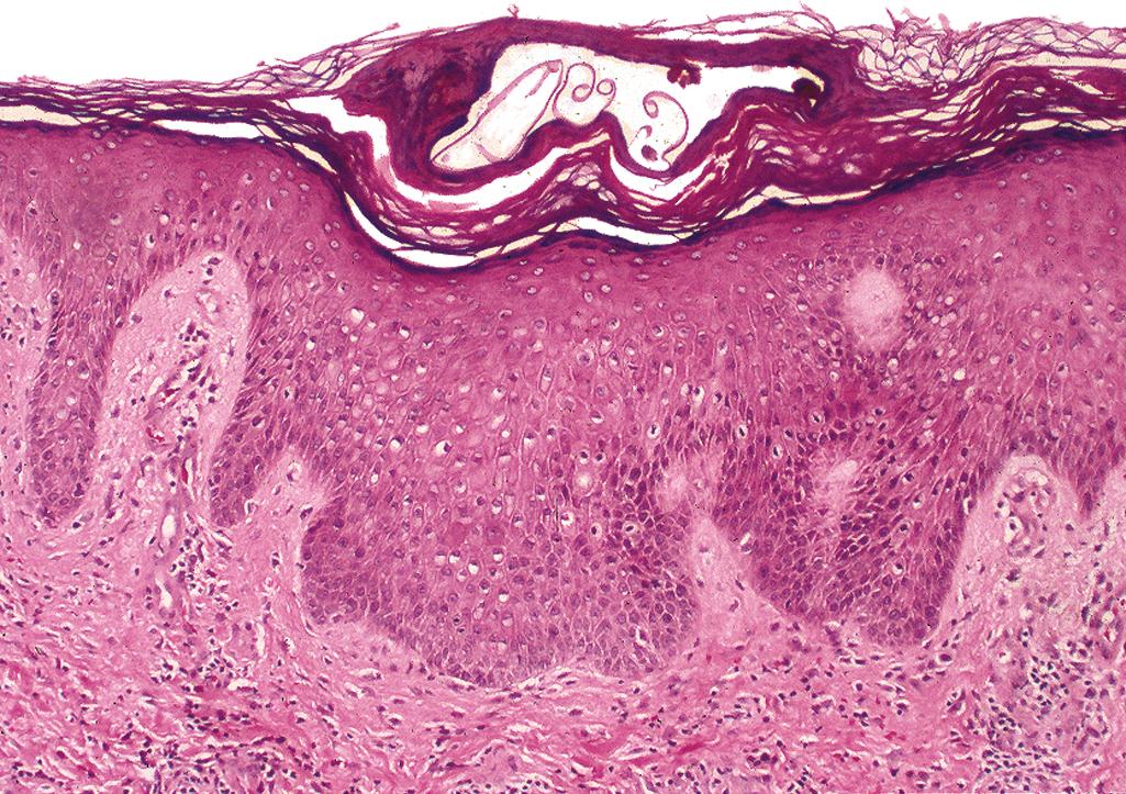 Figure 2.22, Scabies.