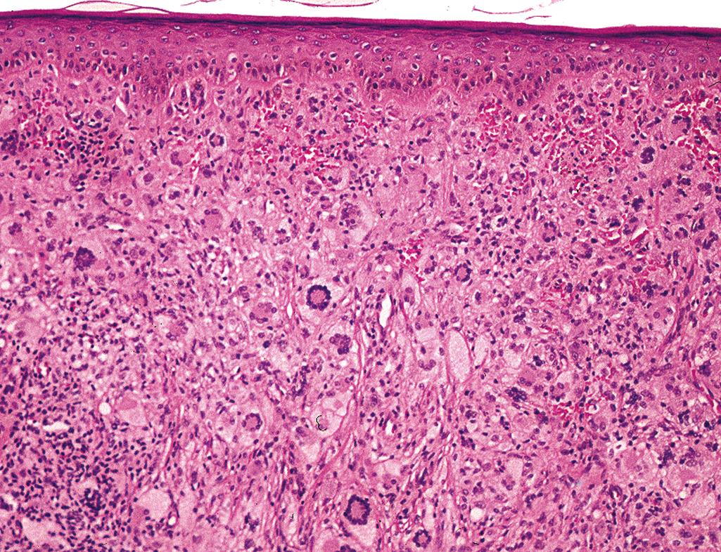 Figure 2.23, Xanthogranuloma.