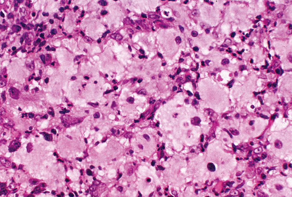 Figure 2.24, Reticulohistiocytic granuloma.