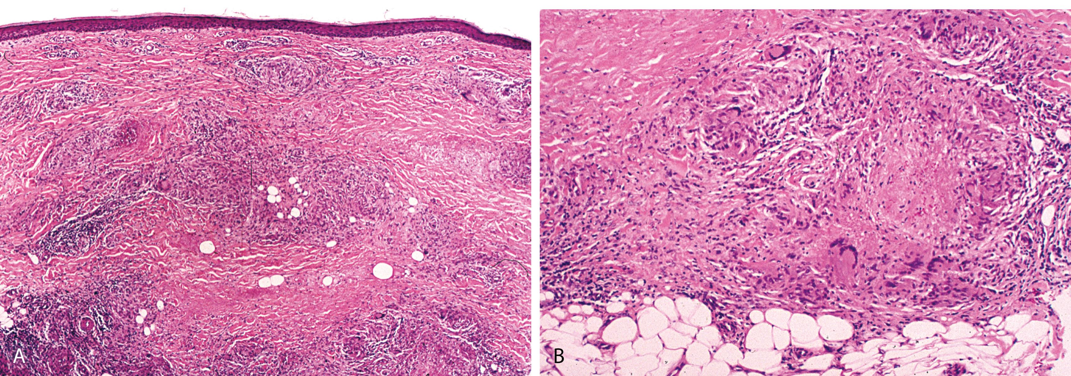 Figure 2.26, Necrobiosis lipoidica.