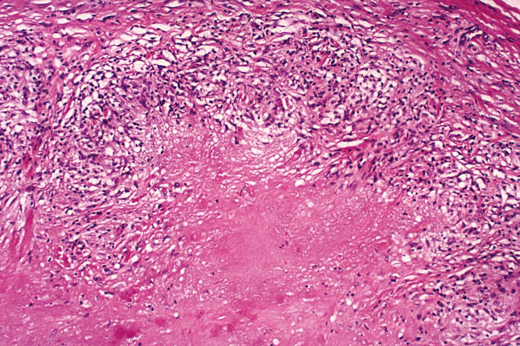 Figure 2.27, Rheumatoid nodule.