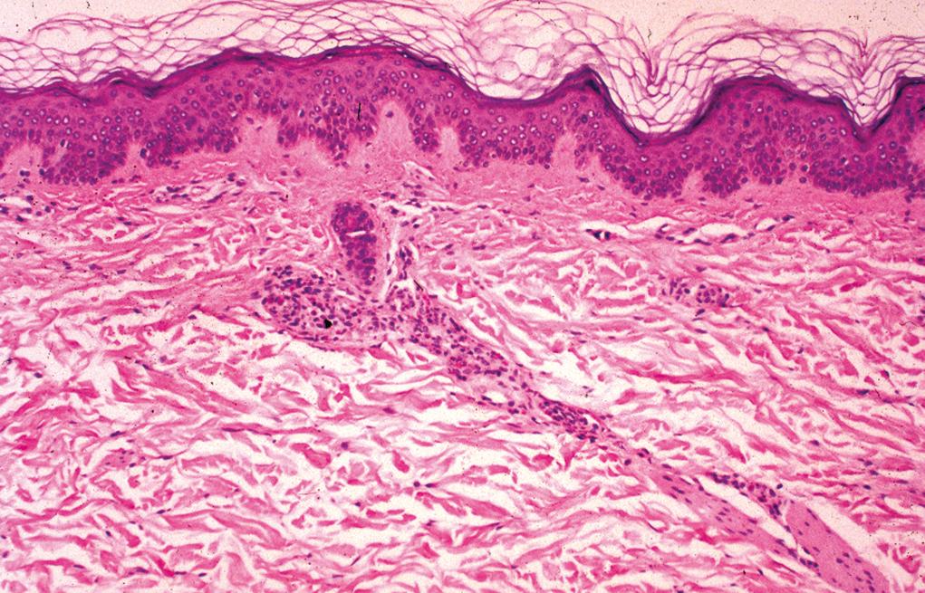 Figure 2.3, Urticaria.