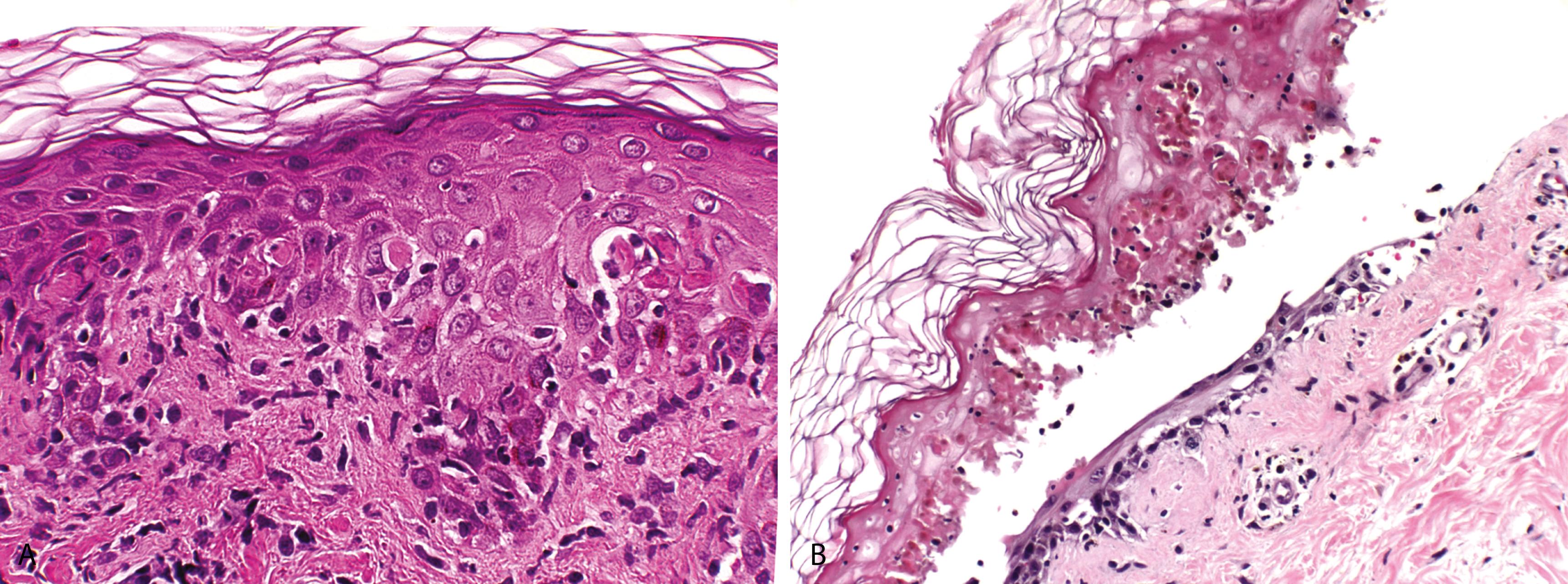 Figure 2.6, A, Erythema multiforme. Vacuolar alteration of the basal cell layer above which there are necrotic keratinocytes. B, Toxic epidermal necrolysis. Full-thickness epidermal necrosis with separation at the dermoepidermal junction. The cornified layer is unaltered, attesting to the acute nature of the process, and there is only a minimal inflammatory cell infiltrate.