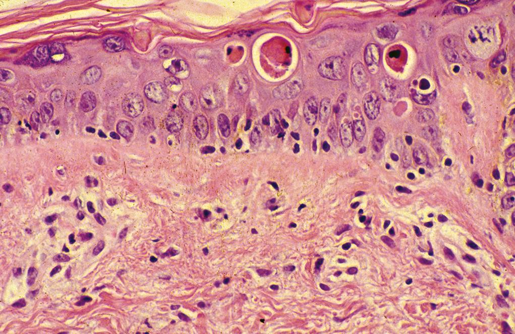 Figure 2.7, Acute graft-versus-host disease.