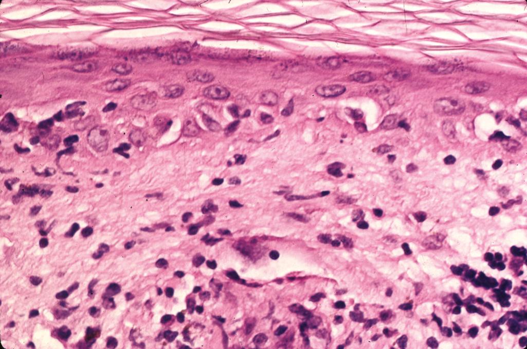 Figure 2.9, Dermatomyositis.