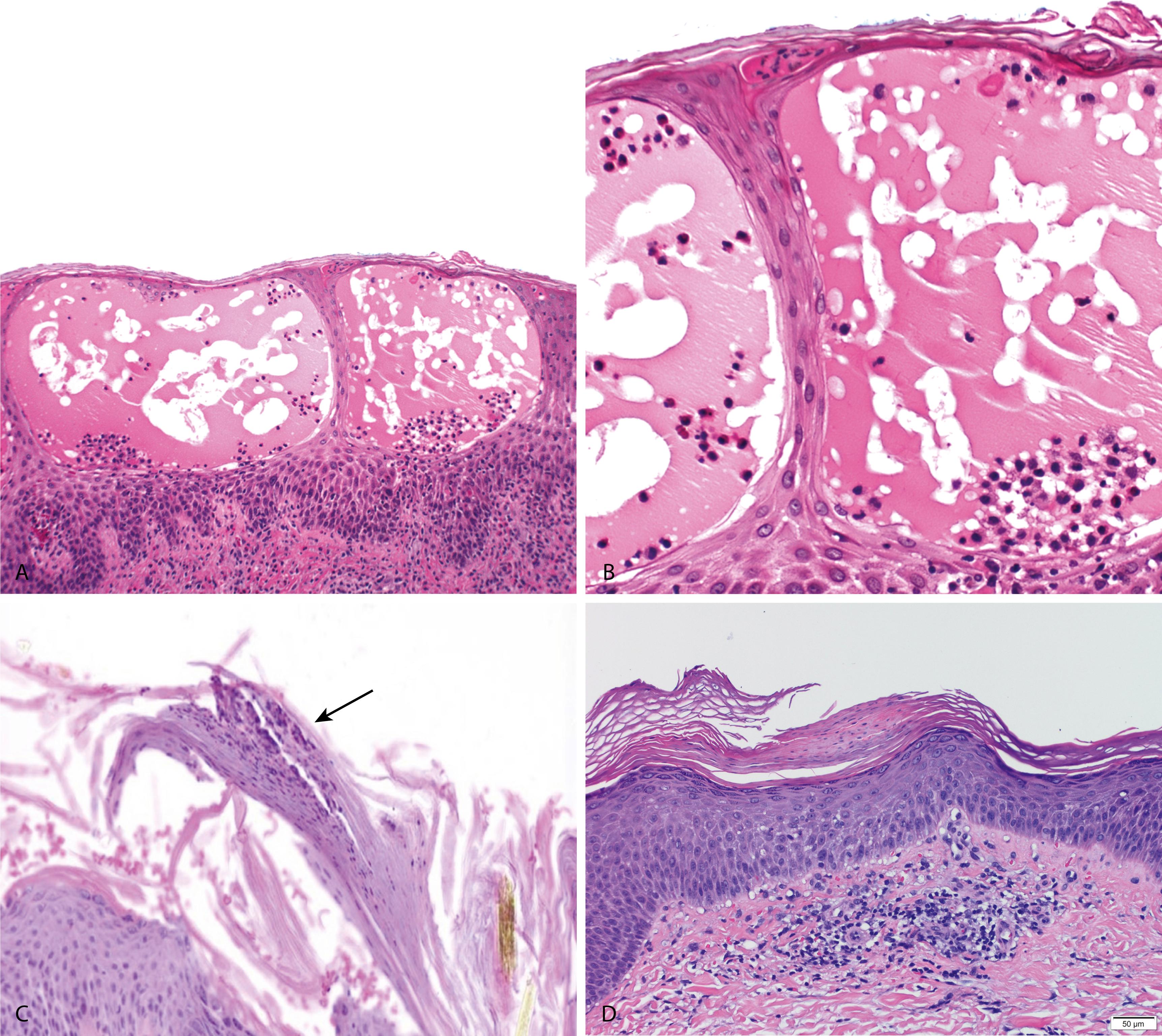 Figure 2.10, Spongiotic dermatitis.