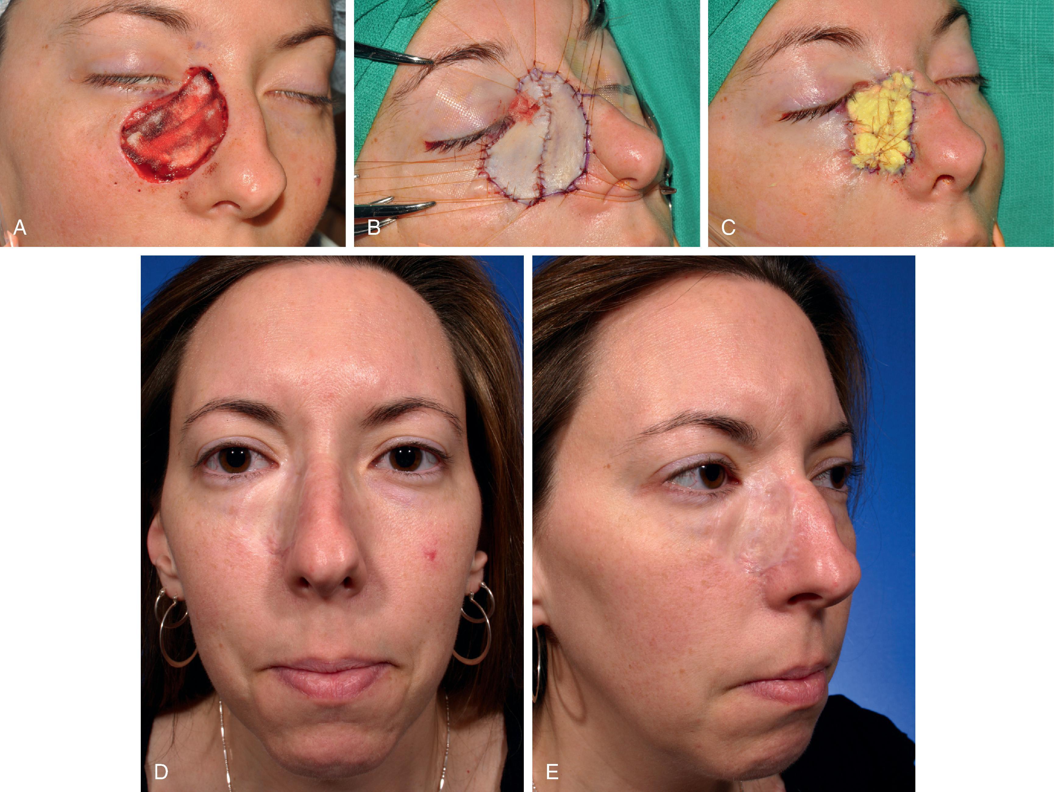 FIG. 15.1, A , A 4.5 × 4.2 cm skin defect after micrographic excision of basal cell carcinoma in a 34-year-old woman. B , C , Repair with full-thickness skin graft from supraclavicular fossa. D , E , Eleven months postoperative. No revision surgery performed. Graft has poor color and textural match with facial skin. (Courtesy Shan R. Baker, MD.)
