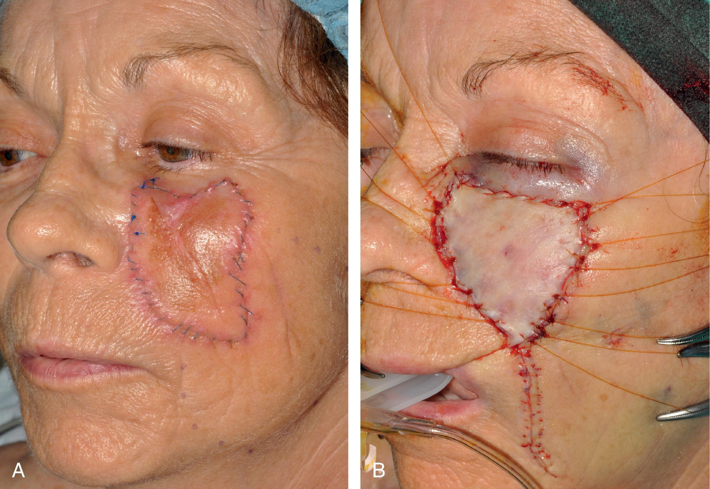 FIG. 15.2, A , A 5 × 4 cm melanoma in situ. Suture line marks planned excision. B , Melanoma excised. Resulting wound partially closed primarily. Remaining wound covered with 3.5 × 4.0 cm full-thickness skin graft harvested from the supraclavicular fossa. C , D , One year postoperative. Z-plasties performed at superior border of graft. (Courtesy Shan R. Baker, MD.)
