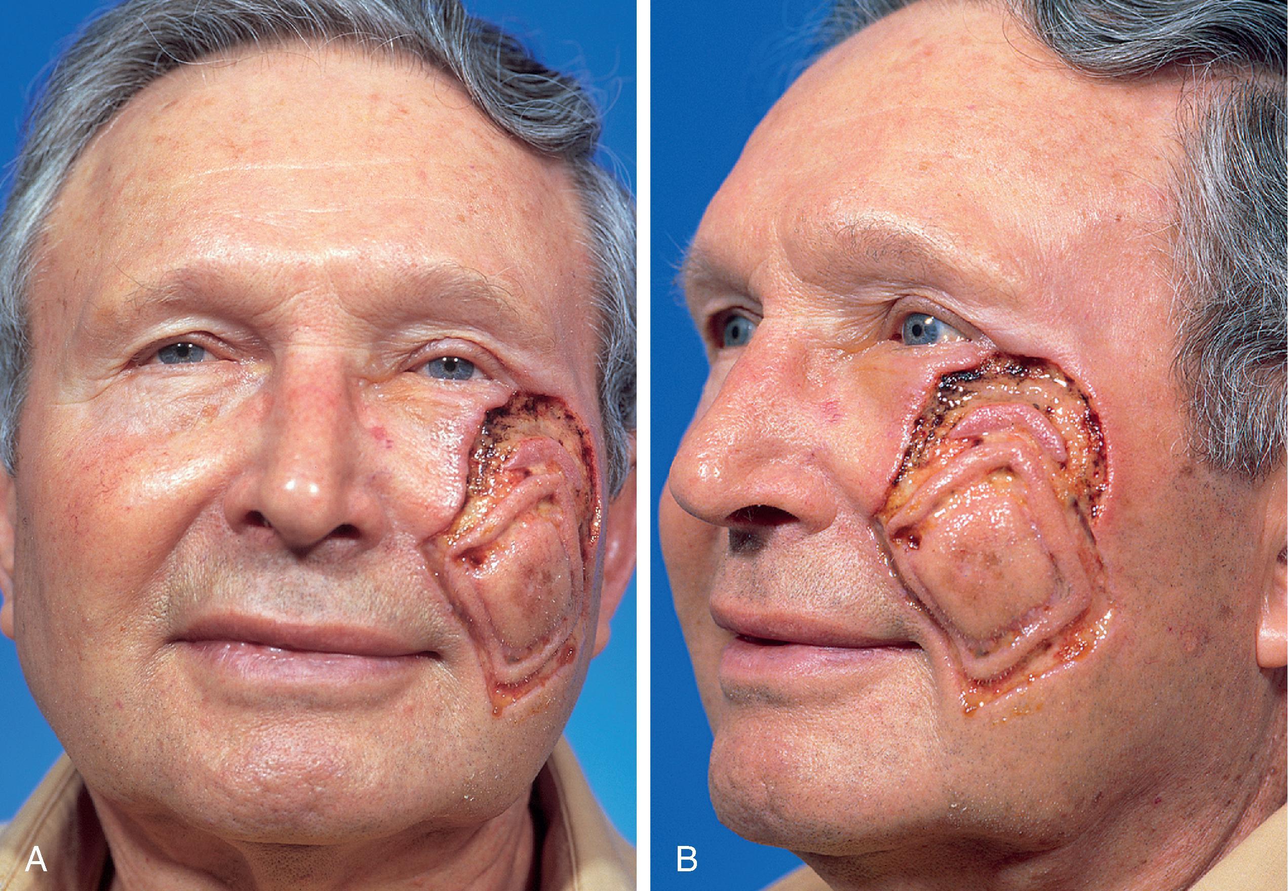 FIG. 15.3, A , B , Lentigo maligna of cheek outlined by linear incisions from attempts to obtain tumor free margins prior to complete resection (square technique – see Chapter 8 ). Resected area (7 × 6 cm) was reconstructed with full-thickness skin graft harvested from supraclavicular fossa. C , D , Ten months postoperative. Skin graft provided an excellent color and textural match with native facial skin. No revision surgery performed. (Courtesy Shan R. Baker, MD.)