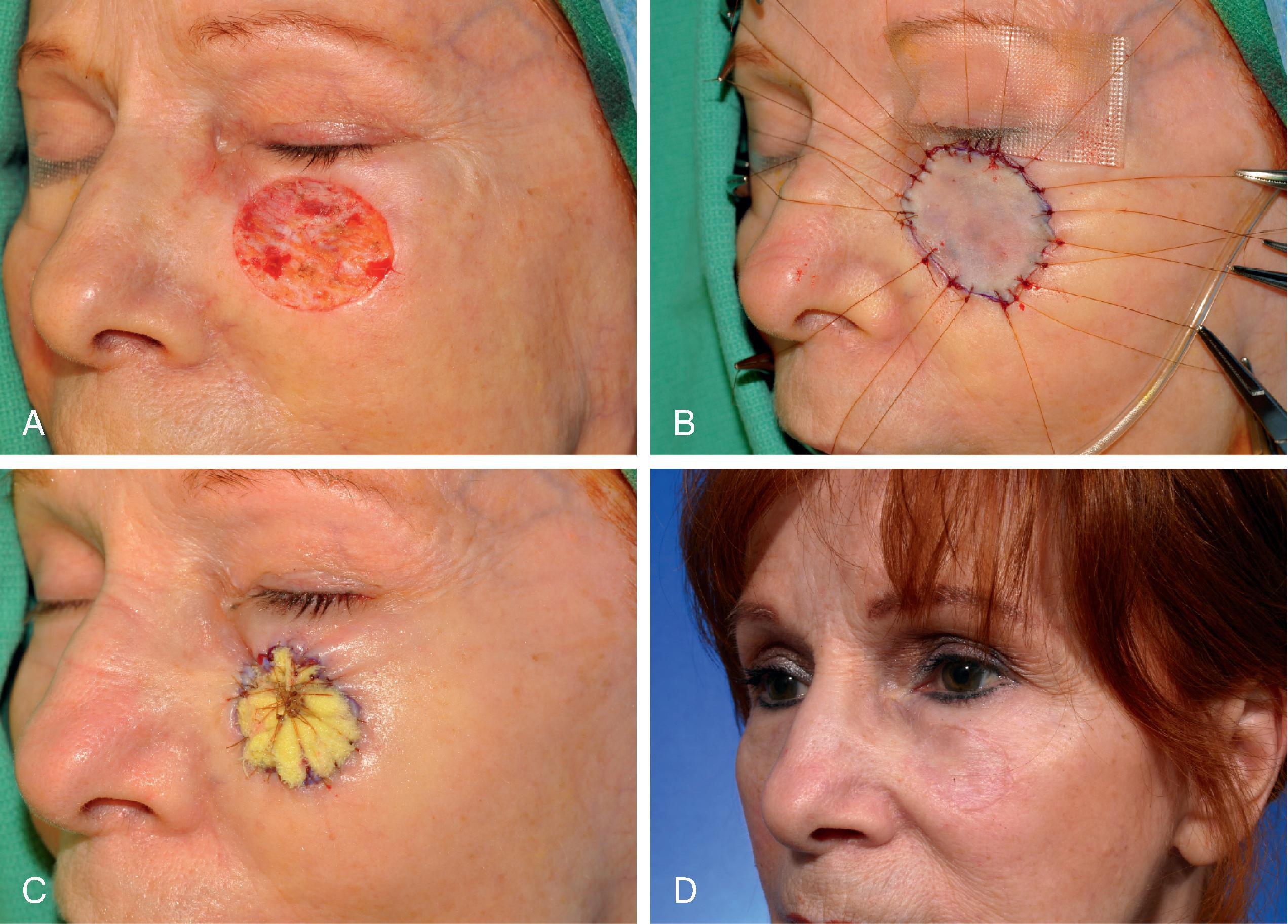 FIG. 15.4, A , A 3 × 2.7 cm skin defect of cheek after micrographic excision of squamous cell carcinoma. B , Defect repaired with full-thickness skin graft from supraclavicular fossa. C , Gauze bolster dressing secures graft in place for 5 days. D , One year postoperative. (Courtesy Shan R. Baker, MD.)