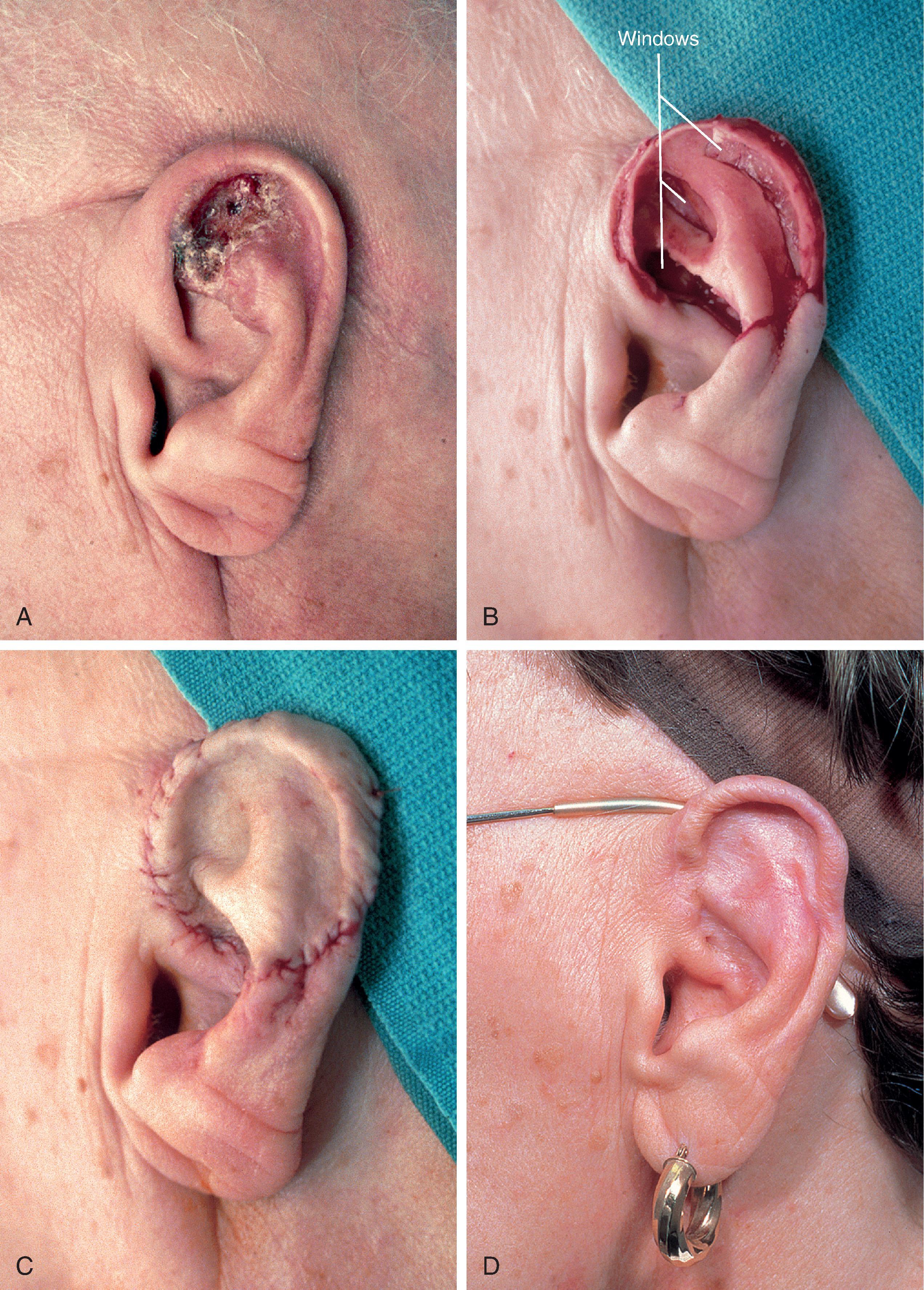 FIG. 15.5, A , Basal cell carcinoma of auricle. B , After tumor resection, windows made through cartilage for portals of ingrowth of blood vessels to nourish skin graft. C , Thin full-thickness skin graft in place. D , Six months postoperative. No revision surgery performed. (Courtesy Shan R. Baker, MD.)