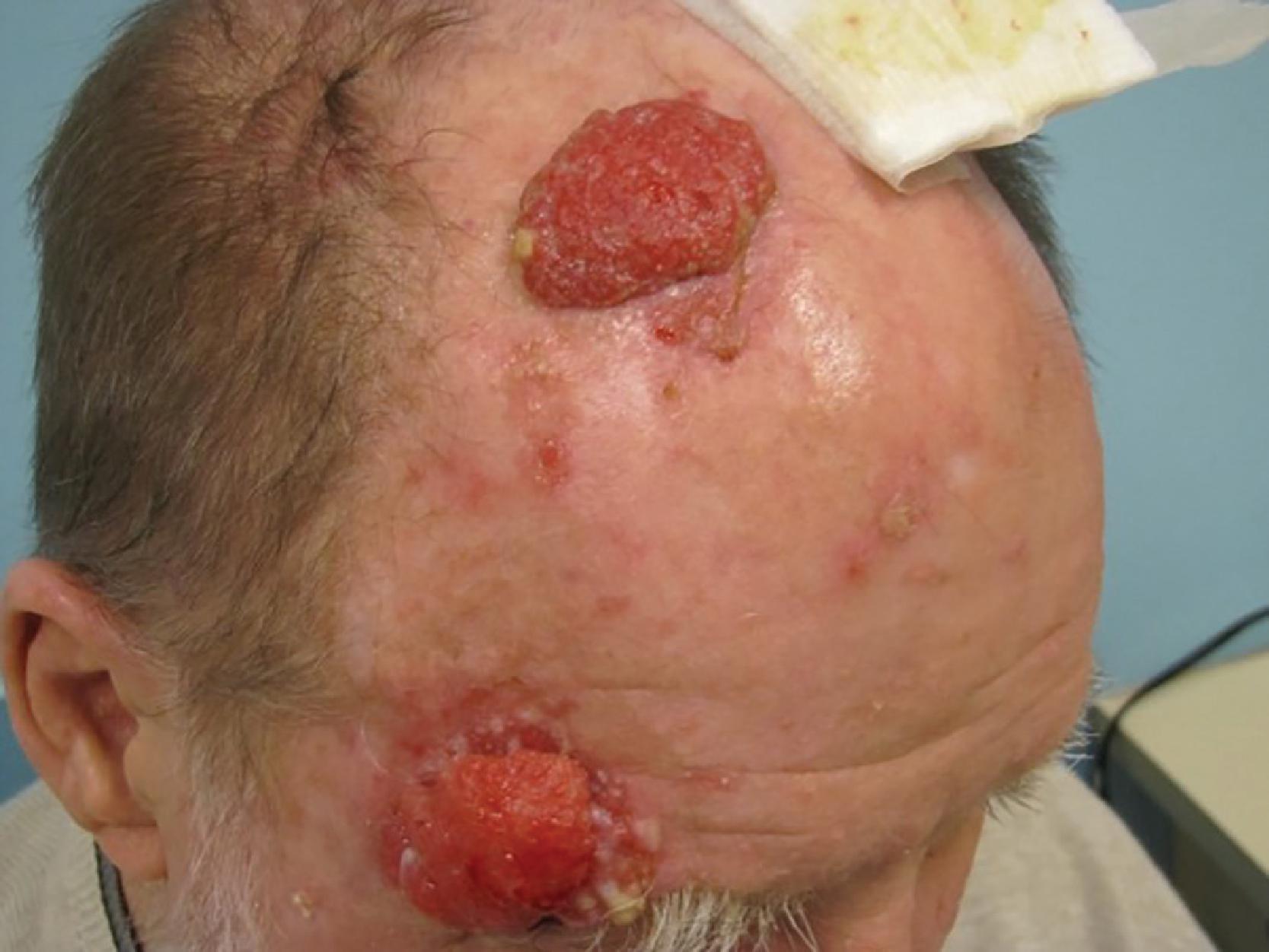 FIG. 1, Cutaneous malignancies in organ transplant recipients are common and can behave more aggressively than in a similar, immunocompetent patient. This patient, who had a history of kidney transplantation, presented with two large, rapidly growing cutaneous tumors.