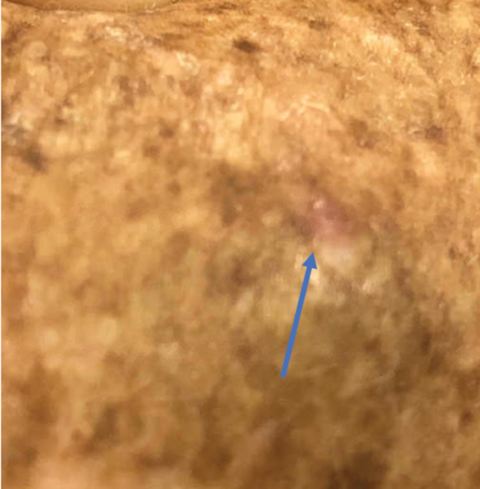 FIG. 8, Amelanotic melanoma. The appearance of these lesions may easily be confused with a benign lesion. The arrow indicates the subtle lesion.