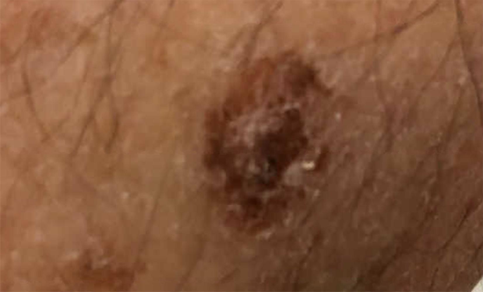 FIG. 9, Desmoplastic melanoma. This lesion was interpreted by the screening dermatologist as a severe keratosis.