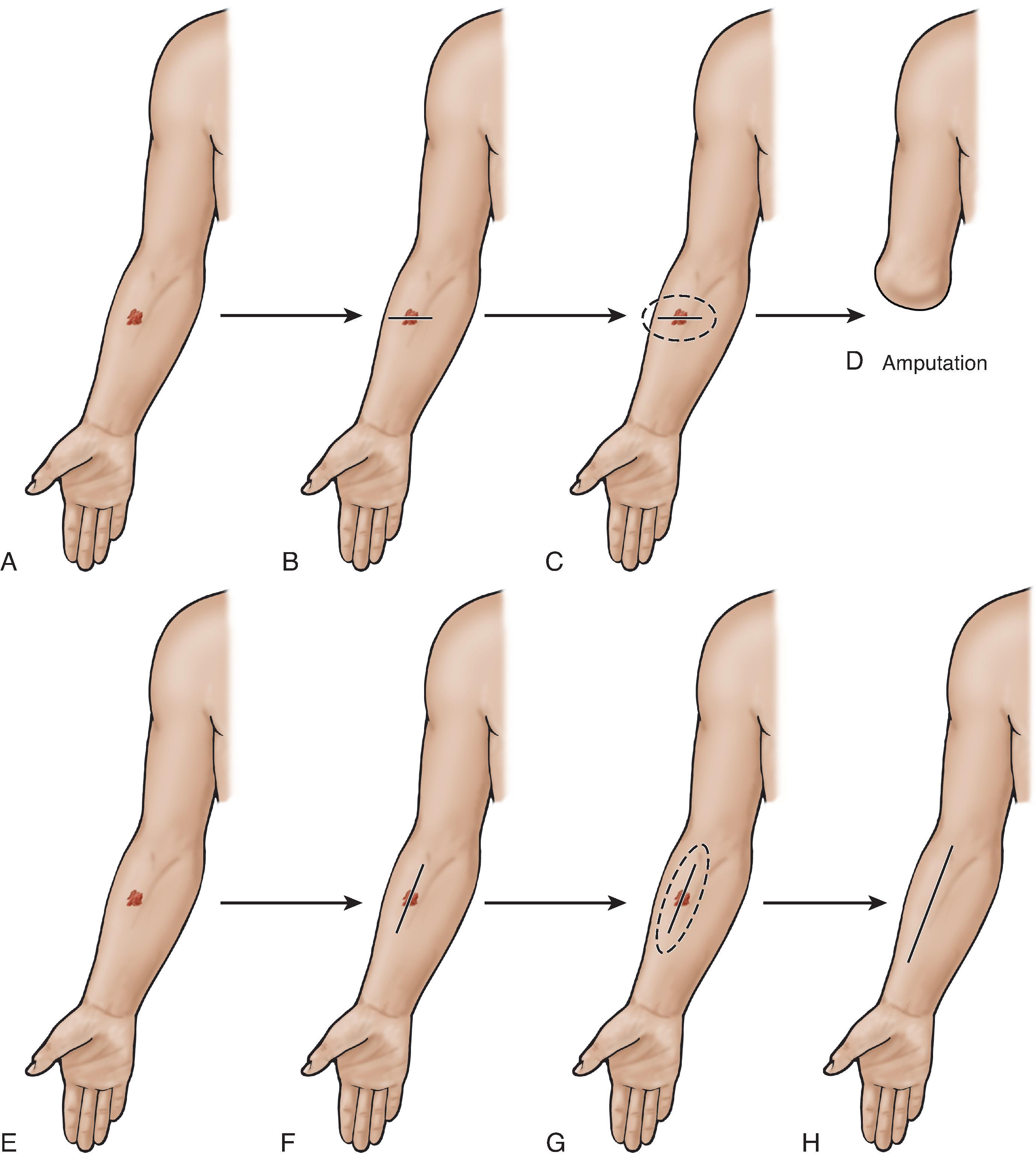 FIG. 10, (A) A suspected melanoma on the volar forearm. (B) A hypothetical transversely oriented incision for excisional biopsy, with a resulting straight-line scar in medial-lateral fashion. (C) The dashed ellipse represents standard excisional margins after pathologic review confirms melanoma. Note that standard margins fall outside the width of the extremity. (D) There are no margins that can be taken in such a fashion as to provide adequate oncologic treatment to preserve limb salvage. Thus, amputation is the only surgical option at this juncture. (E) The same suspected melanoma on the volar forearm. (F) A hypothetical longitudinally oriented incision for excisional biopsy, with a resulting straight-line scar of exact dimension as in (B), but instead in proximal-distal fashion. (G) The dashed ellipse again represents standard excisional margins after confirmed melanoma and is the exact dimension of the ellipse portrayed in (C). (H) Result of re-excision of confirmed melanoma with appropriate margin, though this situation clearly permits an anatomic solution consistent with maximum limb function and preservation.