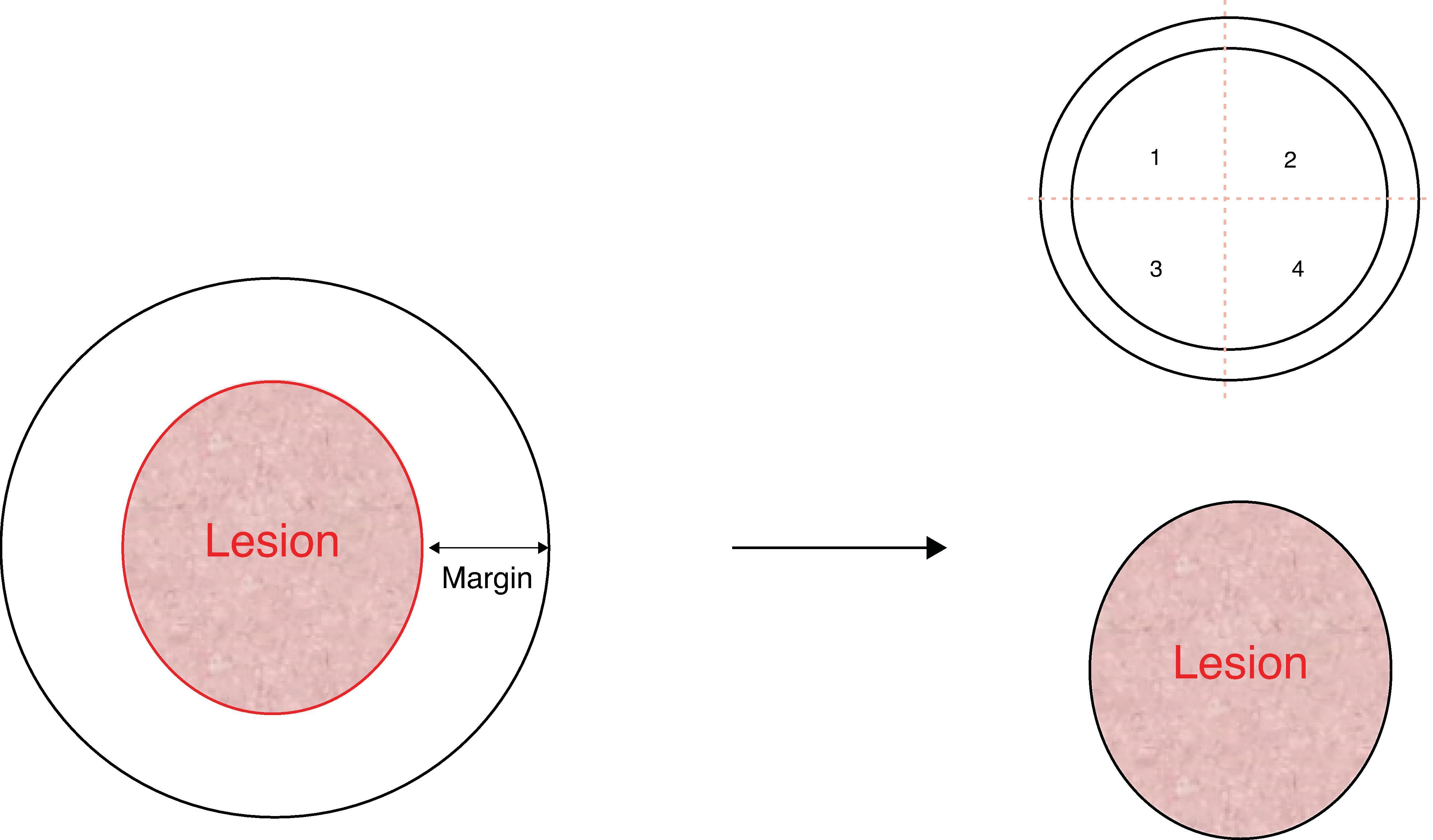 FIG. 3, The authors’ preferred method of excisional biopsy and margin evaluation. The appropriate margin should be measured, and this annulus of tissue is excised. It is recommended to section this into four pieces, which can each be viewed by the pathologists as a linear specimen; it is important to make note of which segments came from which portion of the wound. The lesion itself is then sent as well as its own specimen for pathologic review.