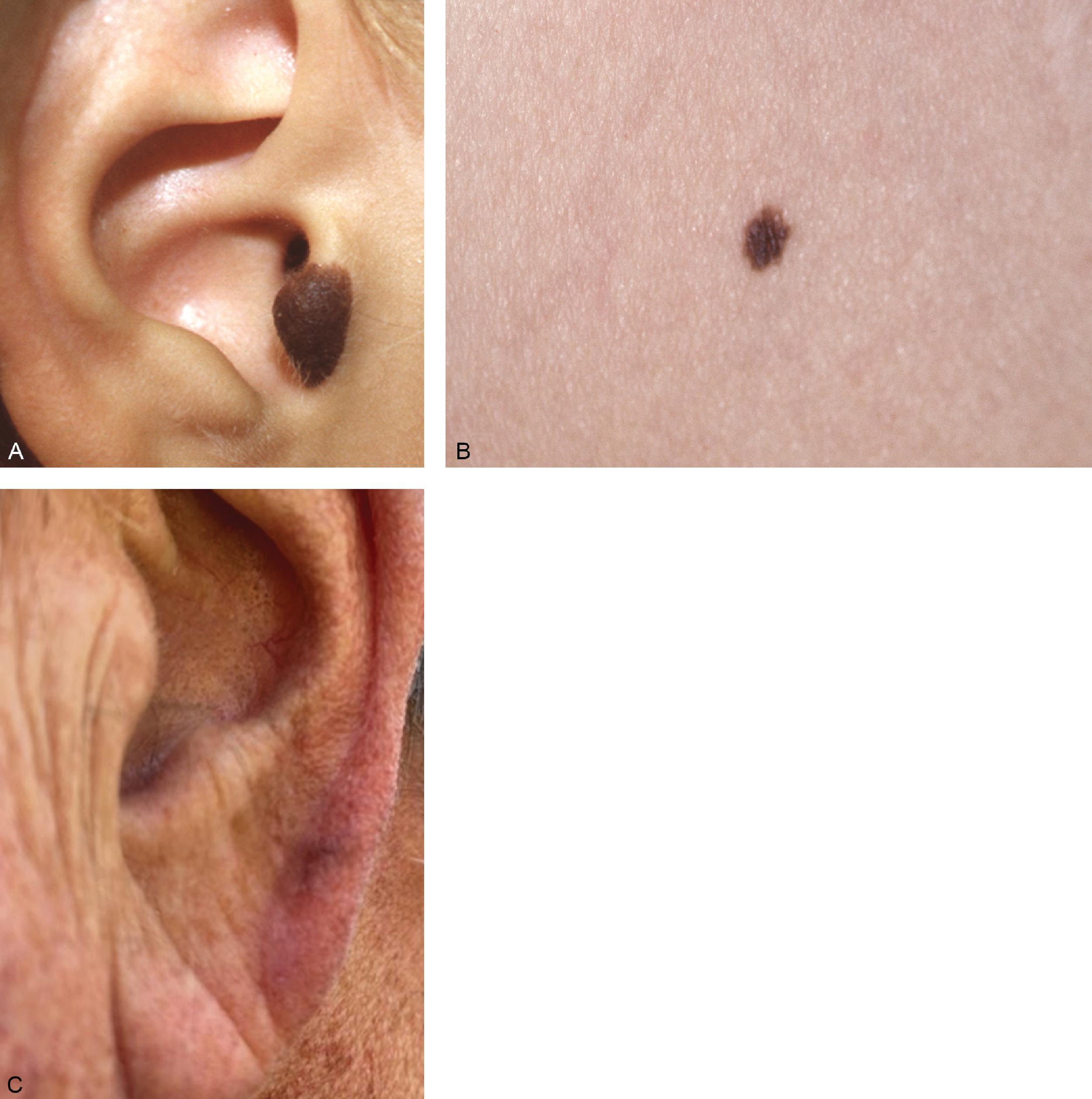 FIG. 2, Dysplastic nevi (possible premelanomas). (A) Deeply pigmented dysplastic nevus. (B) Severe dysplastic nevus with some changes similar to melanoma; it looked like melanoma clinically, but it was a dysplastic nevus pathologically. (C) Melanoma in situ; early malignant melanoma is easily confused with benign lesions.