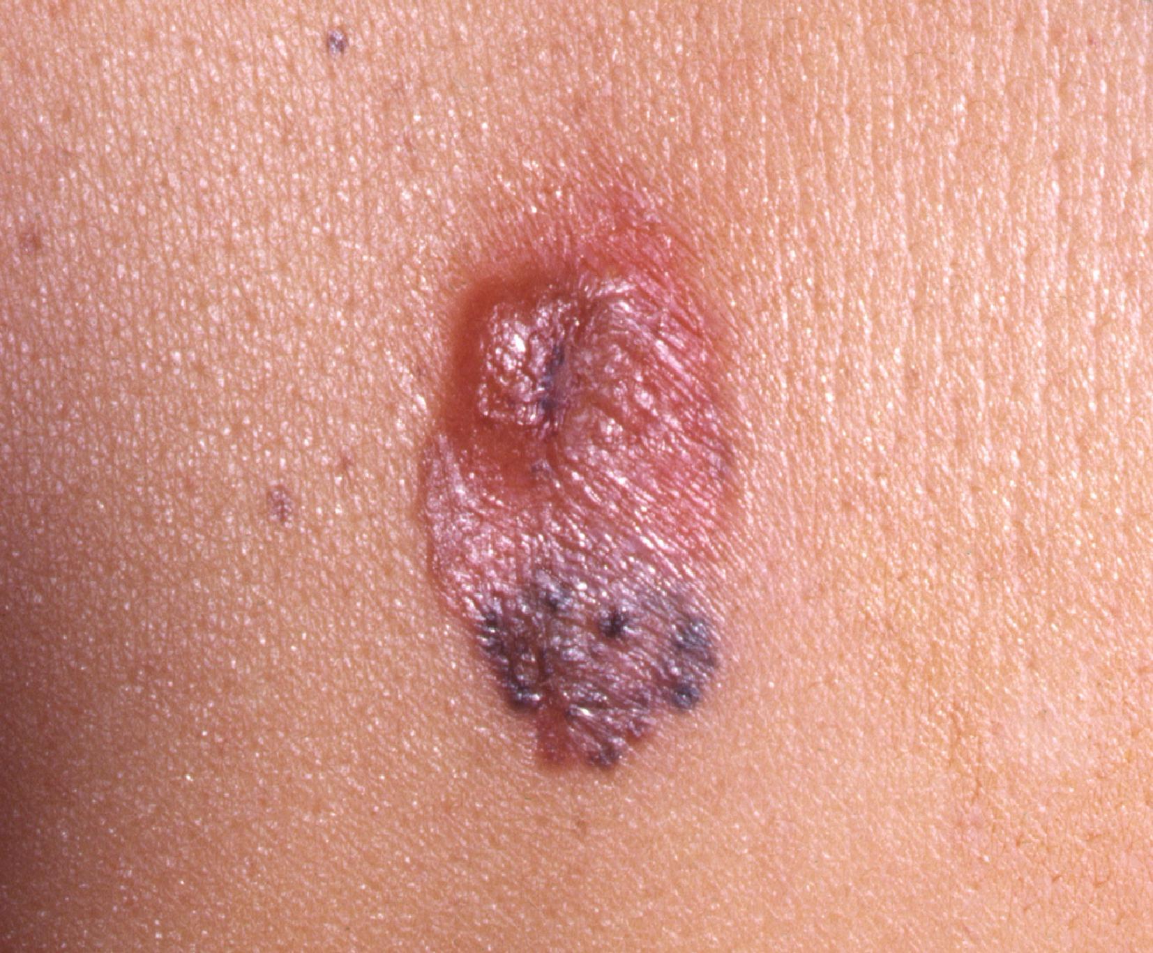 FIG. 3, Superficial spreading melanoma. Combinations of red, blue, and brown pigment are seen. A nodule is developing from one area, indicating that a vertical growth phase is arising contemporaneously with the horizontal or radial growth phase.