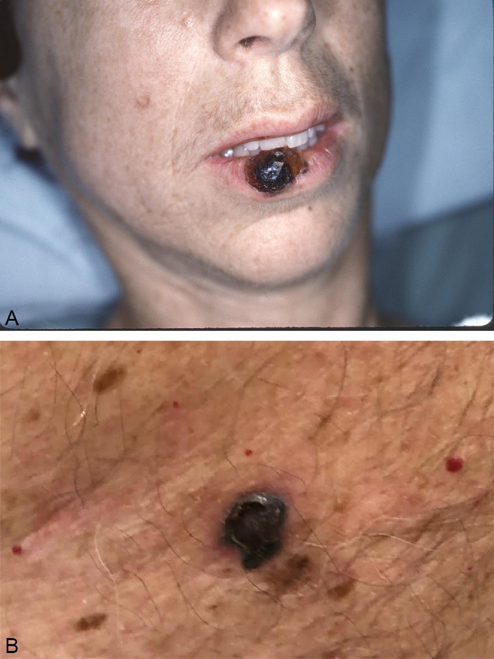 FIG. 4, Nodular melanoma. This is a dark, heavily pigmented lesion with rapid growth. Two examples are shown: lip (A) and back (B).