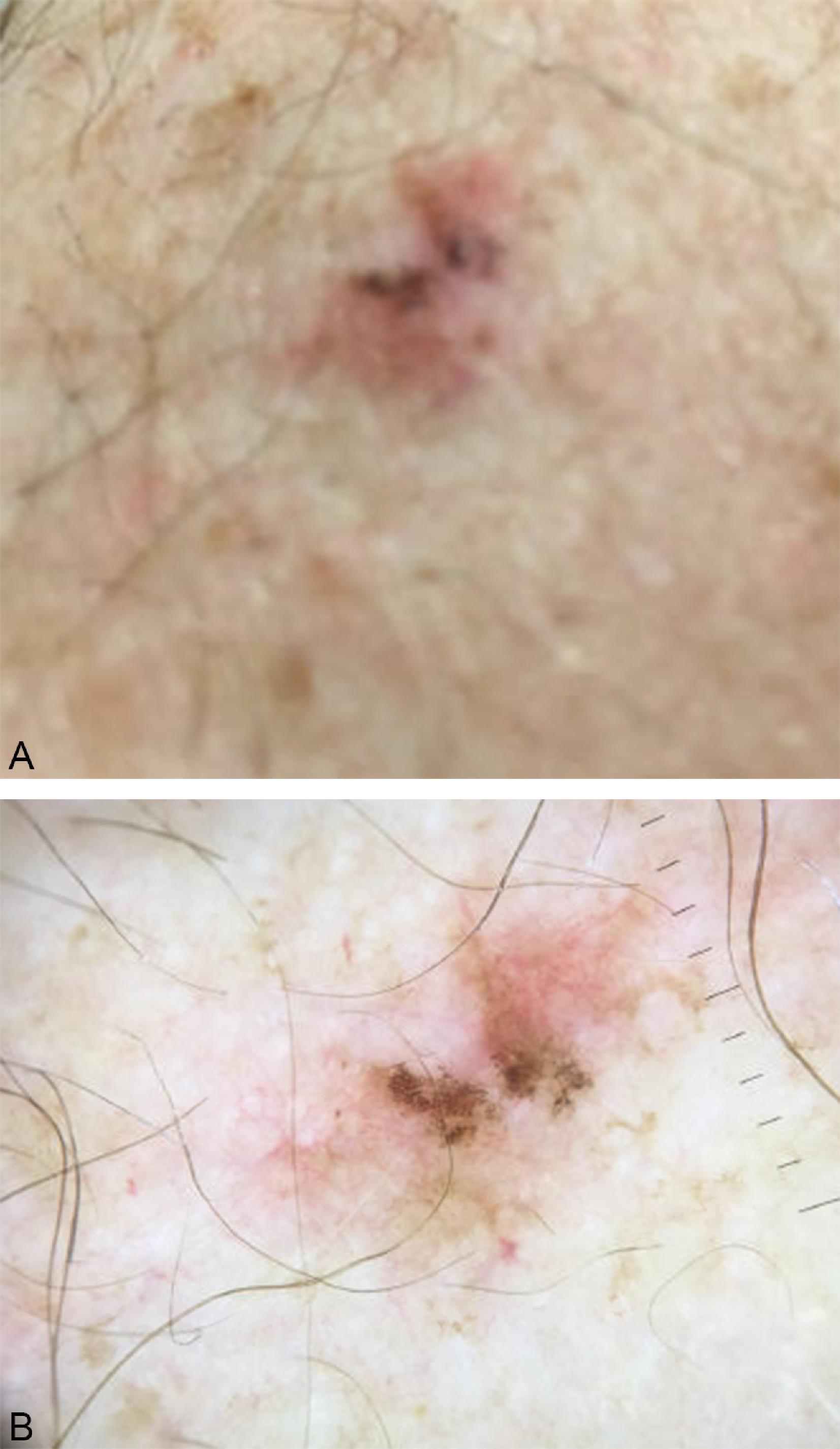 FIG. 5, Lentigo maligna melanoma. (A) Variegated colors of red, brown, and black with considerable pigment variation and multiple areas of regression are shown. (B) The same lesion under magnification clearly demonstrates areas of central and peripheral irregular regression.
