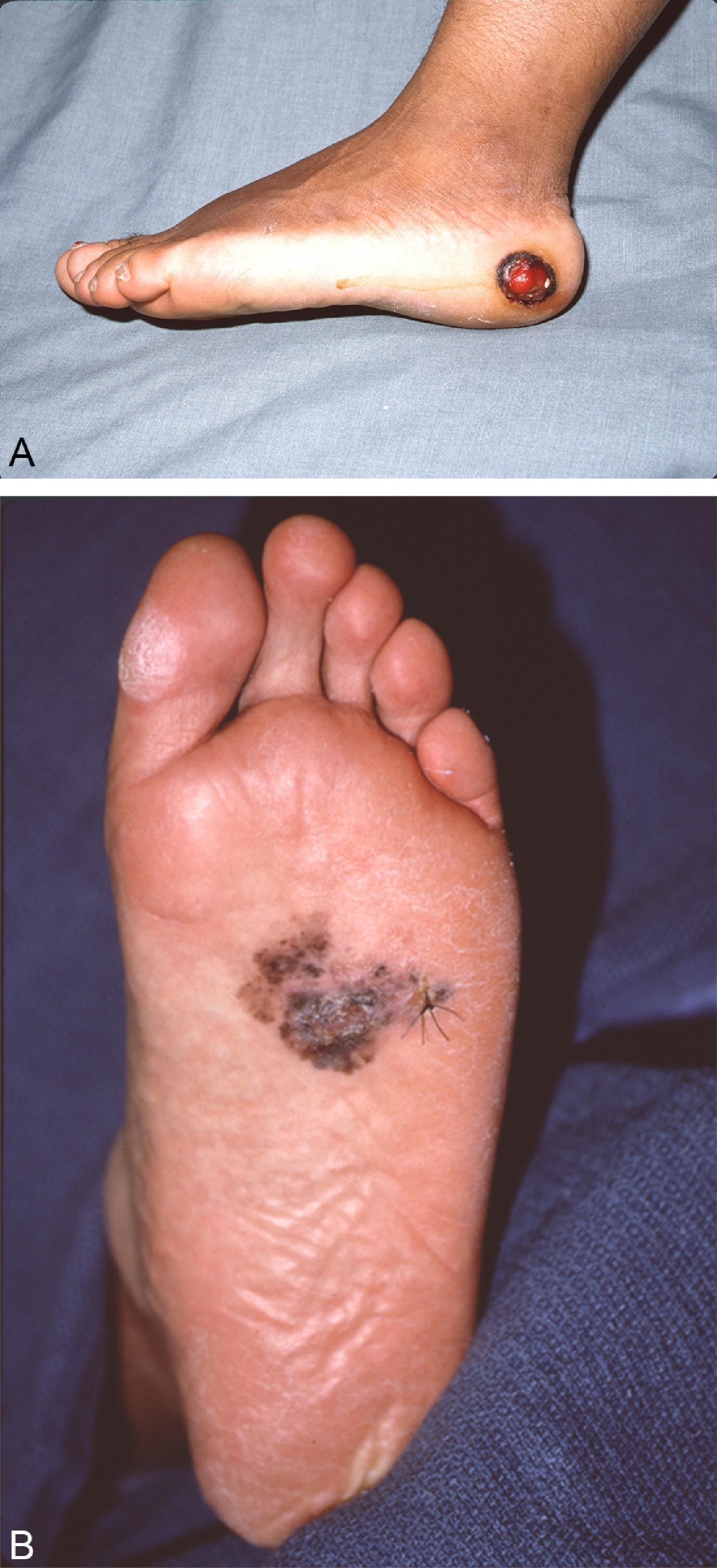 FIG. 6, Acral melanoma. Two variations are shown: nodular (A) and flat (B).