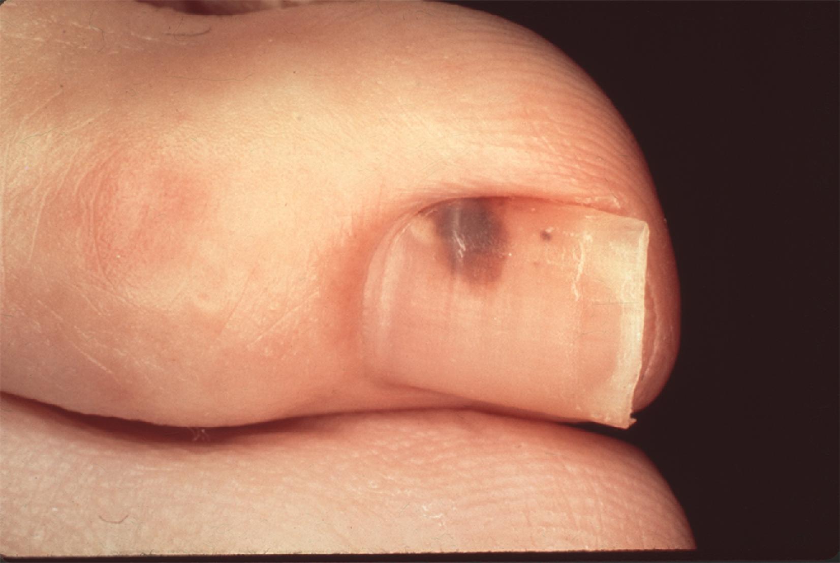 FIG. 7, Nail bed melanoma. This lesion seems to extend beyond the nail bed into the perionychium.
