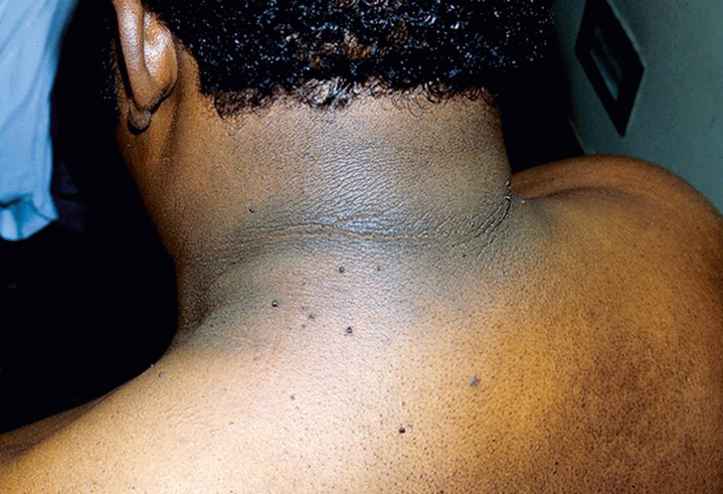 Fig. 24.1, The velvety hyperpigmentation of acanthosis nigricans in a neck crease of a patient with diabetes mellitus.