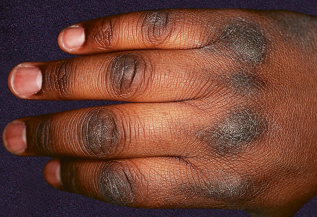 Fig. 24.2, Acanthosis nigricans over the knuckles in a patient with insulin resistance and obesity.