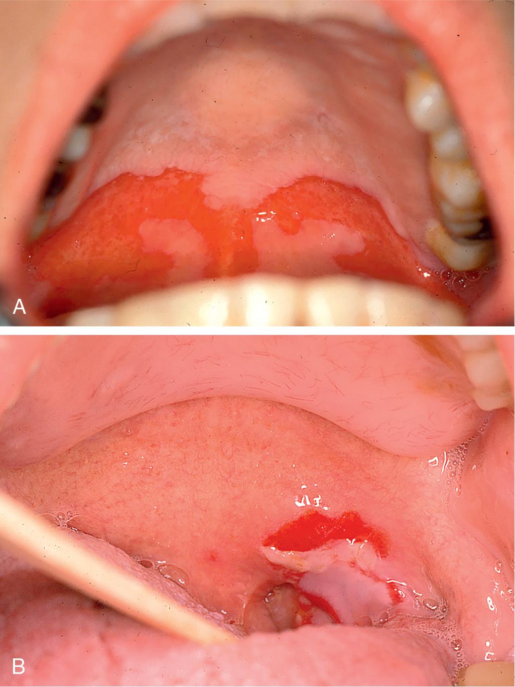 Fig. 24.3, Two images of pemphigus with lesions of the palate. Essentially all patients with pemphigus develop painful oral mucosal erosions, with the most common sites being the buccal and palatine mucosa. These lesions are flaccid, thin-walled, easily ruptured blisters.