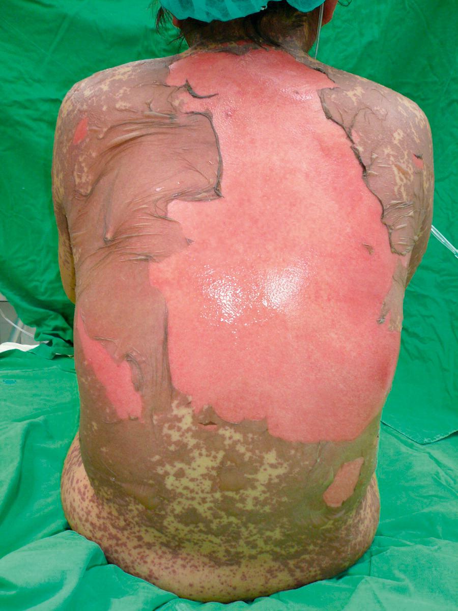 Fig. 24.5, Back lesion in a woman presenting with toxic epidermal necrolysis involving 48% of total body surface area.