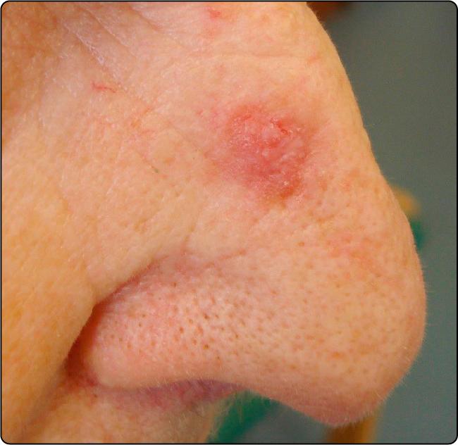 Fig. 55.1, An actinic keratosis.