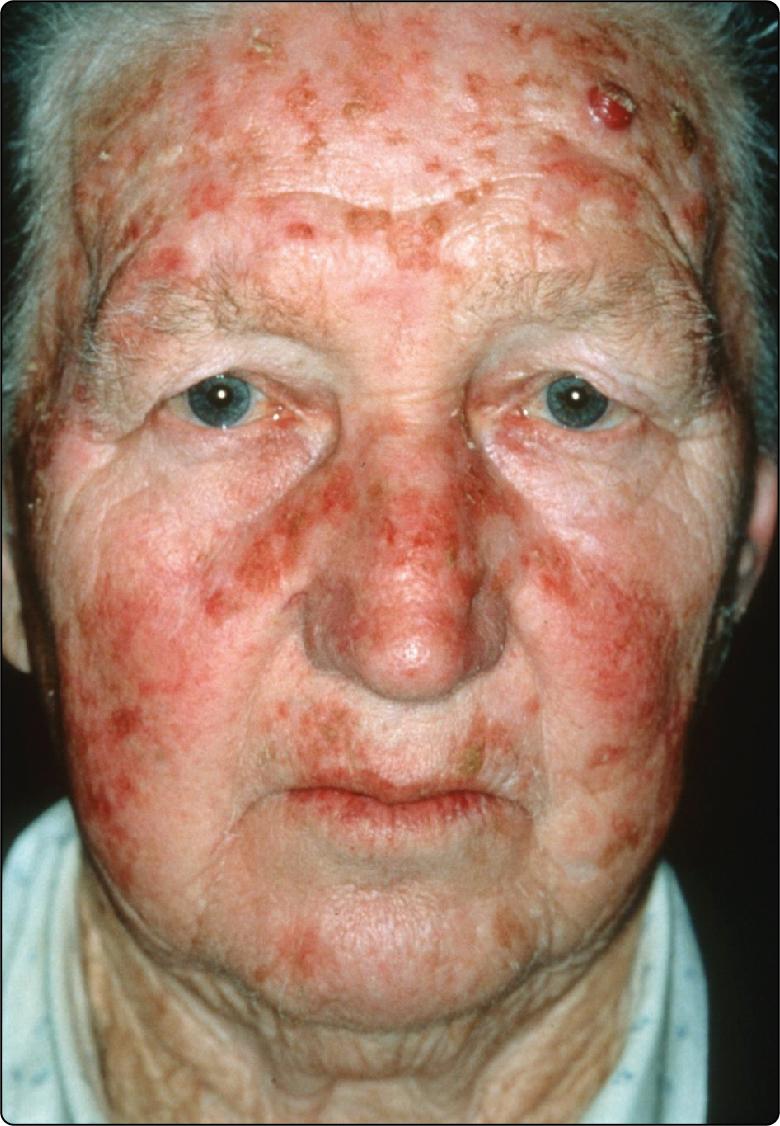 Fig. 55.2, Actinic keratoses (AKs).