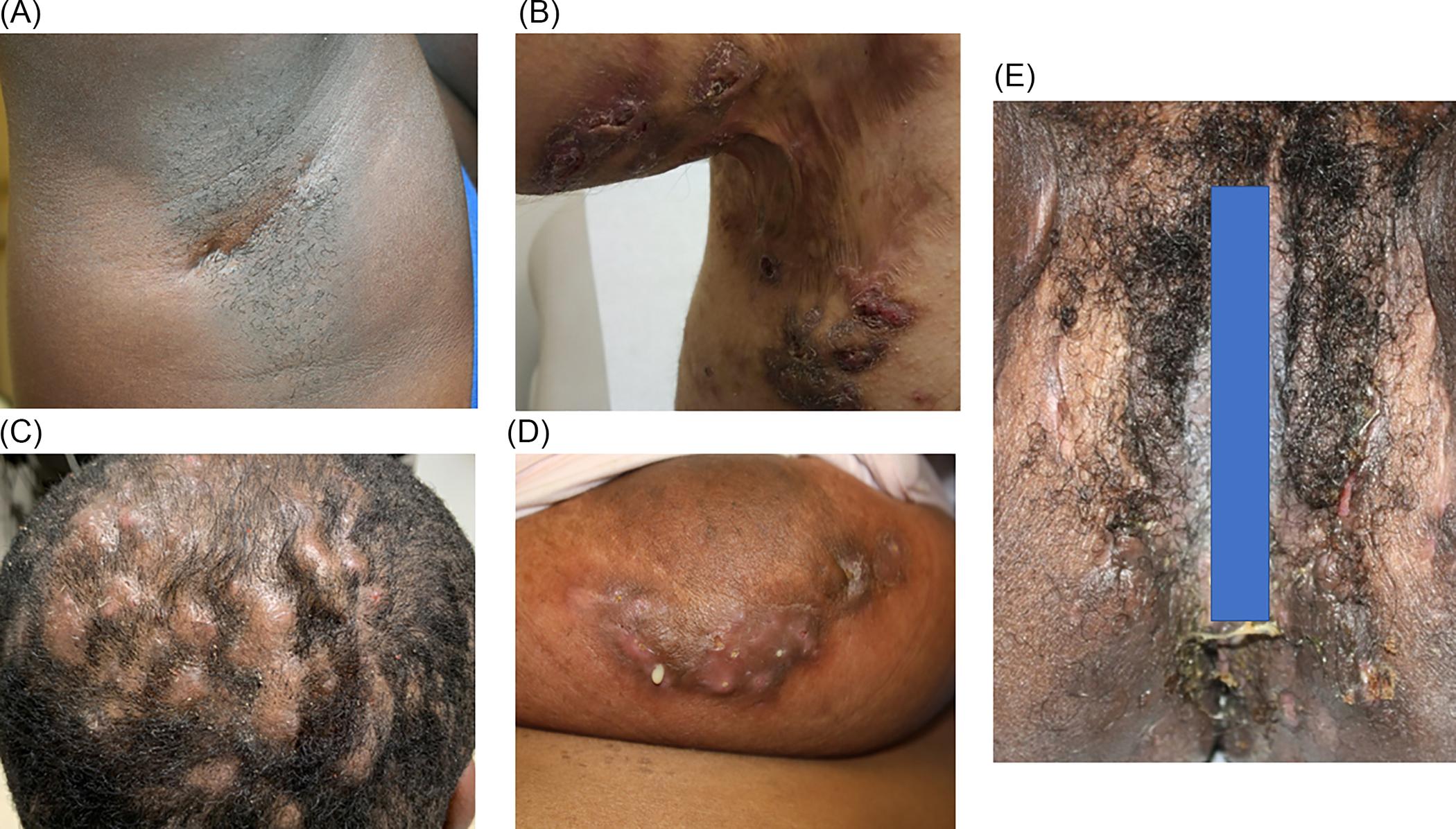 Fig. 30.1, Clinical Presentation of Hidradenitis Suppurativa in Skin of Color.
