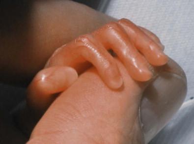 Figure 4.1, Skin of an extremely premature infant (<24 weeks).