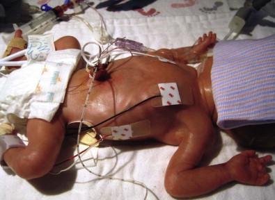 Figure 4.2, Preterm infant in a humidified incubator (opened for purposes of photograph).