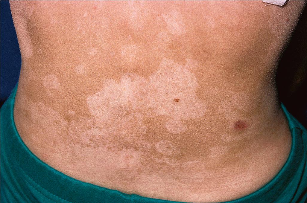 Fig. 25.1, Common variable immunodeficiency (CVID). Individuals with CVID or IgA deficiency have an increased incidence of autoimmune disorders, as evidenced in this adolescent with CVID and vitiligo.