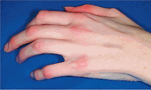 Fig. 25.12, Chronic graft-versus-host disease. Sclerodactyly and subtle telangiectasia overlying the knuckles, as seen in patients with systemic scleroderma and juvenile dermatomyositis.