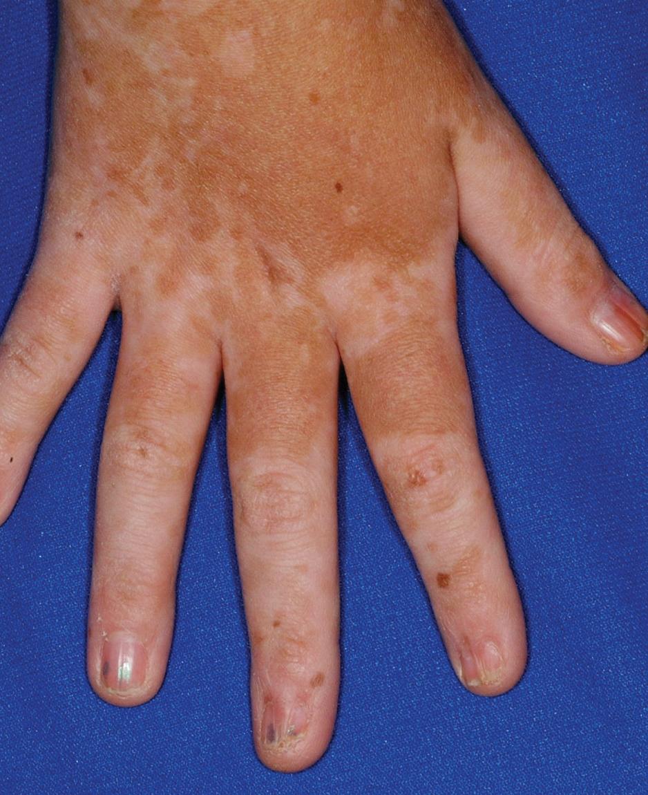 Fig. 25.14, Chronic graft-versus-host disease. Vitiligo on the dorsal aspect of the hands. Note the pterygium formation of the fingernails.