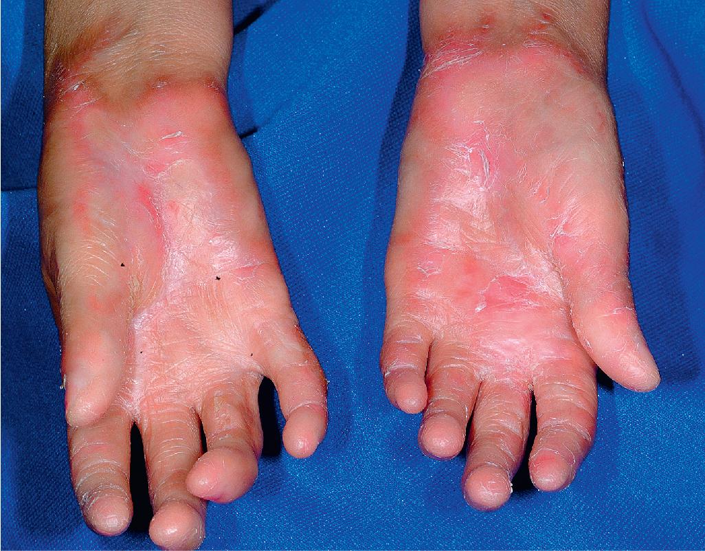 Fig. 25.13, Chronic graft-versus-host disease (GVHD). Sclerodactyly and generalized scaling were noted at birth in this girl with immunodeficiency and in utero GVHD.