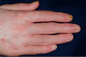 Fig. 25.15, Chronic graft-versus-host disease. Note the cutaneous atrophy and nail dystrophy, including onycholysis and pterygium formation, resembling the nails of lichen planus.