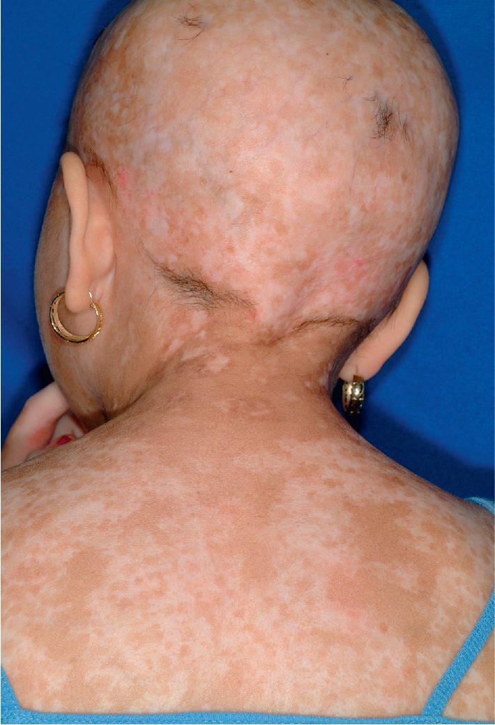 Fig. 25.16, Chronic graft-versus-host disease. Note the extensive alopecia of the scalp with dyschromia and numerous sclerodermatous plaques of the scalp and back.