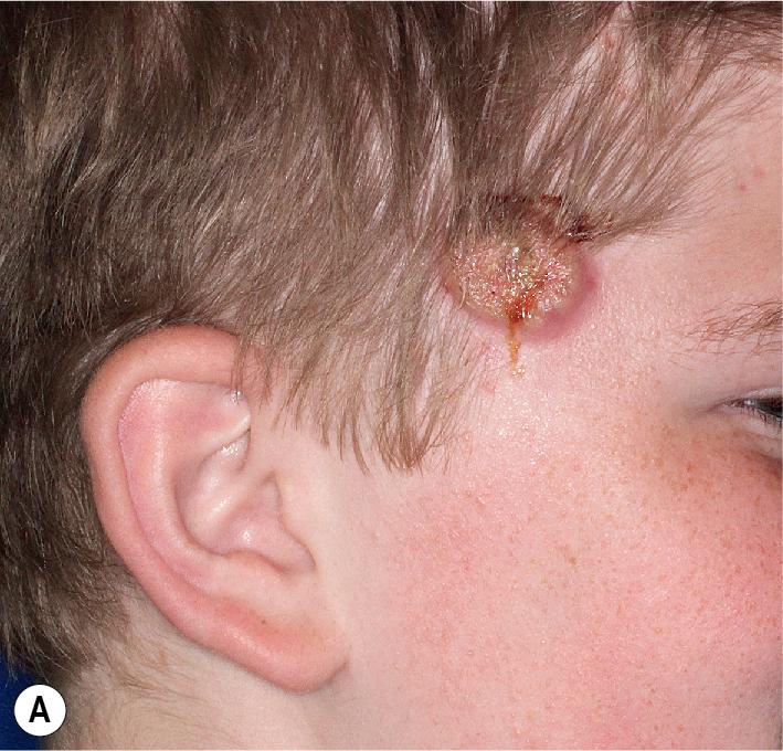 Fig. 25.33, Pyogenic sterile arthritis, pyoderma gangrenosum, and acne (PAPA) syndrome. This 11-year-old boy had small inflammatory papules of acne on the face, which rapidly became purulent plaques (A) and then ulcerated to form pyoderma gangrenosum, leaving residual scars. He also had arthritis. His disease was brought under control with golimumab (TNF inhibitor) and isotretinoin throughout adolescence, but in his early twenties (without isotretinoin) he developed mild truncal acne and recurrence of the pyoderma gangrenosum (B) .