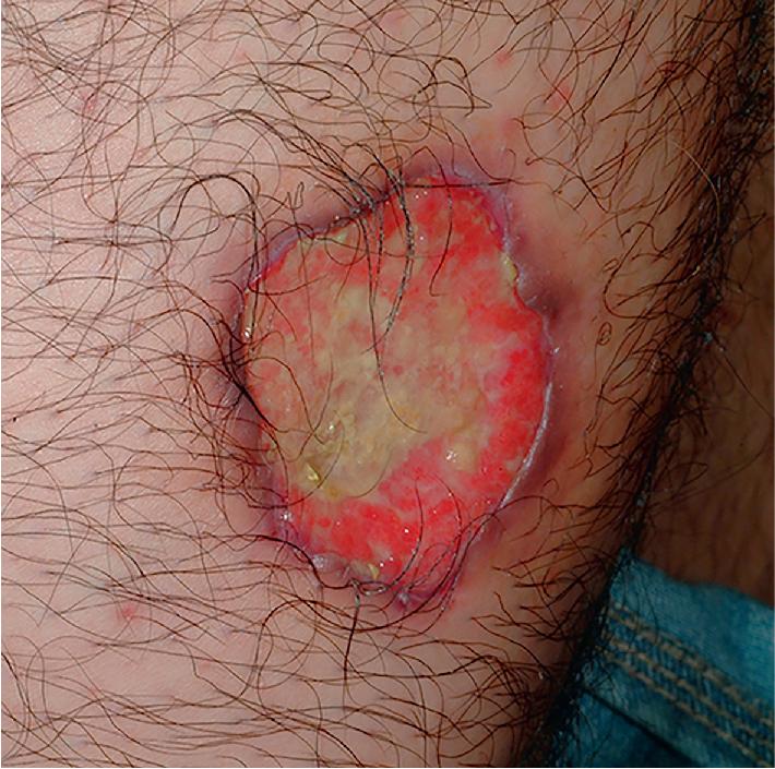 Fig. 25.18, Pyoderma gangrenosum. Painful leg ulceration with an inflamed, undermined border. Note the pustule distal to the ulceration, often the earliest sign of a new site of involvement. The most common underlying condition in affected children is inflammatory bowel disease, although no underlying abnormality may be discovered.