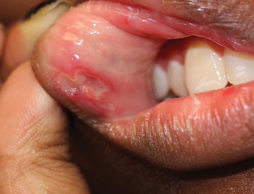 Fig. 25.20, Behçet disease. Large, painful ulceration on the buccal mucosa.