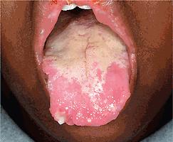 Fig. 25.21, Behçet disease. Major and minor aphthae on the tongue. Note the scalloping of the tongue border from past scarring lesions.